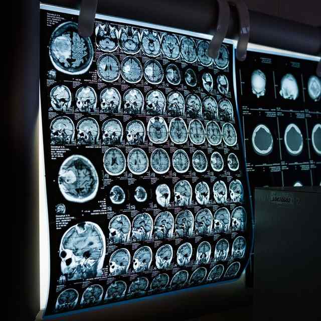 an AI model to analyze patient data to diagnose Alzheimer&rsquo;s disease